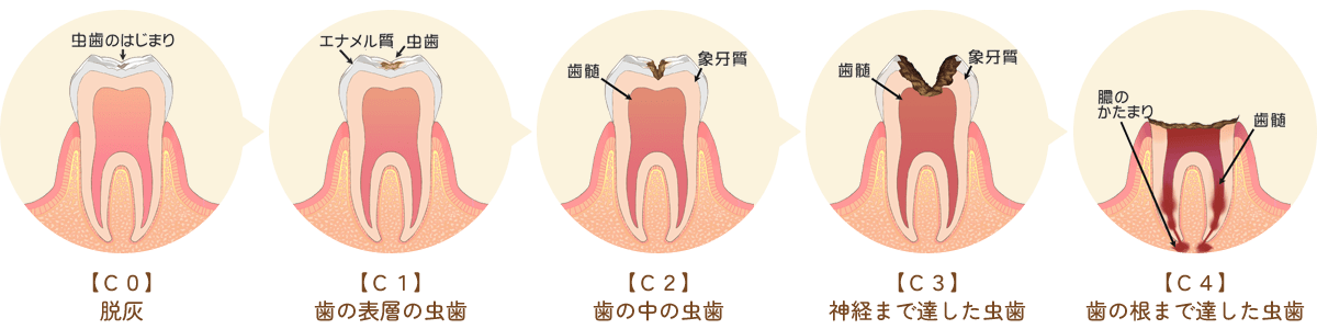 虫歯治療の進行