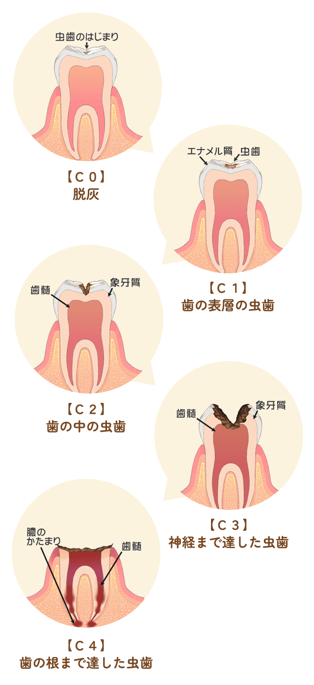 虫歯治療の進行