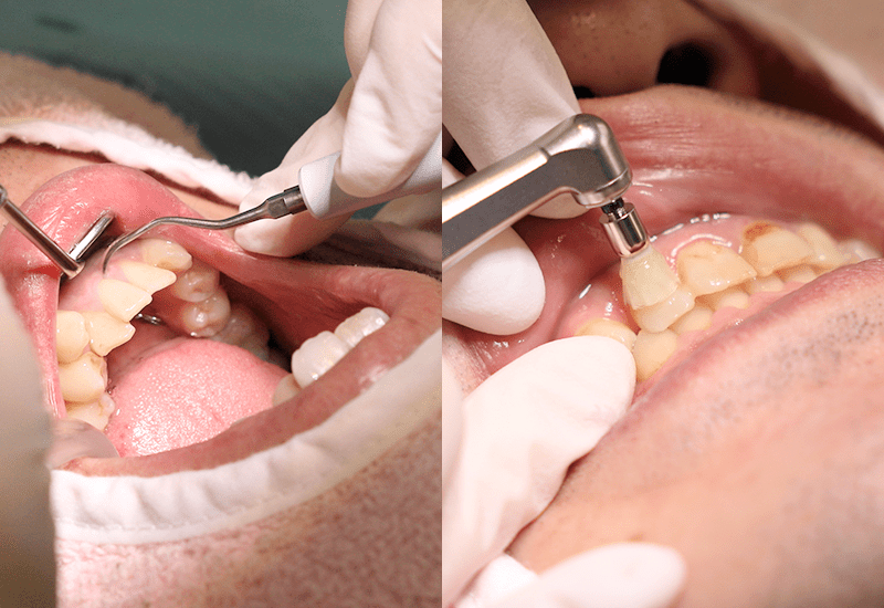 歯石とり・クリーニング