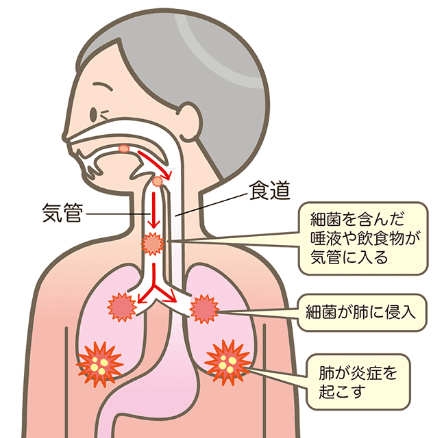 誤嚥性肺炎